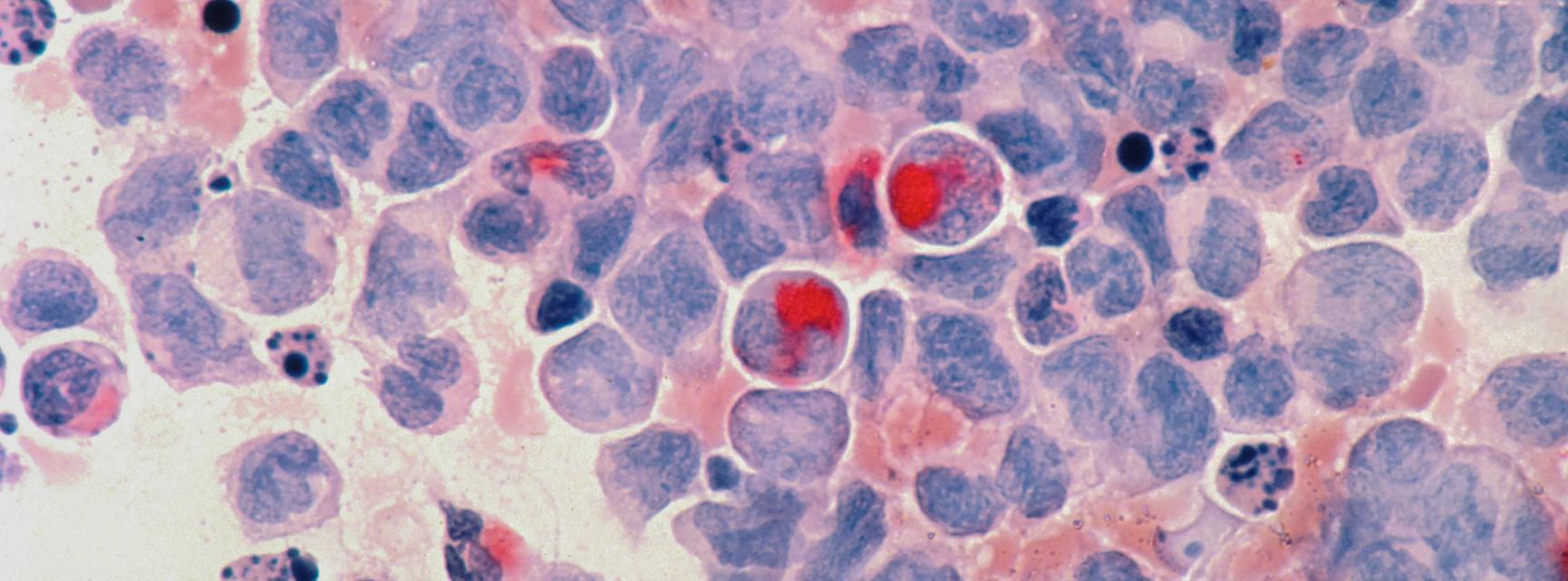 Acute myelocytic leukaemia (AML), Photo by National Cancer Institute on Unsplash 