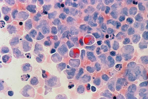 Acute myelocytic leukaemia (AML), Photo by National Cancer Institute on Unsplash 